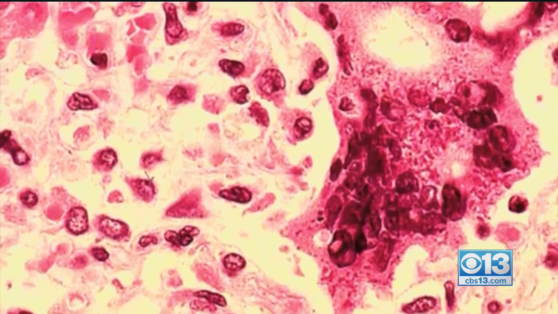 Old Virus Resurfaces In Calaveras County As Young Child Contracts Measles